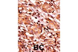 Formalin-fixed and paraffin-embedded human cancer tissue reacted with BAD (phospho S134) polyclonal antibody  which was peroxidase-conjugated to the secondary antibody followed by AEC staining. (BAD anticorps  (pSer170. pSer134))