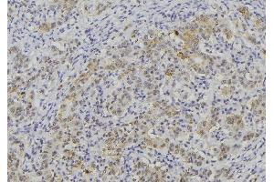 ABIN6276383 at 1/100 staining Human lung cancer tissue by IHC-P. (WNT3A anticorps  (Internal Region))