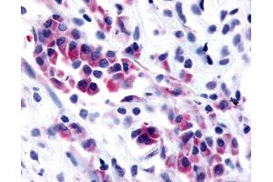 Anti-NEK9 antibody IHC of human Breast, Carcinoma.