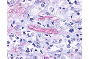 Anti-GPR124 / TEM5 antibody IHC of human Prostate, Carcinoma Endothelial Cells.