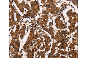 Immunohistochemistry of Human thyroid cancer using ATRN Polyclonal Antibody at dilution of 1:50 (Attractin anticorps)