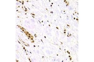 Immunohistochemistry of paraffin-embedded human gastric cancer using RAD50 Antibody. (RAD50 anticorps)