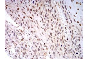 Immunohistochemical analysis of paraffin-embedded esophageal cancer tissues using LGALS1 mouse mAb with DAB staining.