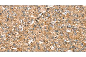 Immunohistochemistry of paraffin-embedded Human liver cancer using MORF4L1 Polyclonal Antibody at dilution of 1:35