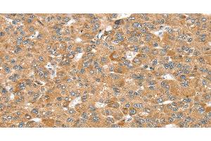 Immunohistochemistry of paraffin-embedded Human liver cancer using MORF4L1 Polyclonal Antibody at dilution of 1:35 (MORF4L1 anticorps)