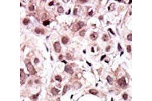 IHC analysis of FFPE human cancer tissue stained with the AXL antibody (AXL anticorps  (AA 13-44))