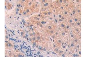 Detection of LOXL4 in Human Liver cancer Tissue using Polyclonal Antibody to Lysyl Oxidase Like Protein 4 (LOXL4)