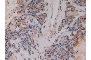 IHC-P analysis of Human Lung Cancer Tissue, with DAB staining. (CKMT1A anticorps  (AA 41-250))