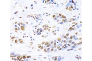 Immunohistochemistry of paraffin-embedded Human breast cancer using XRCC5 Polyclonal Antibody at dilution of 1:100 (40x lens).