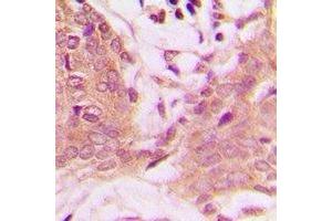 Immunohistochemical analysis of PEA15 (pS116) staining in human breast cancer formalin fixed paraffin embedded tissue section.