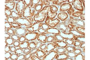 Formalin-fixed, paraffin-embedded human Renal Cell Carcinoma stained with Erythropoietin Mouse Monoclonal Antibody (EPO/1368). (EPO anticorps  (AA 28-162))