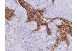 Immunohistochemistry staining of colorectal carcinoma (paraffin-embedded sections) with anti-human CD66e (CB30).