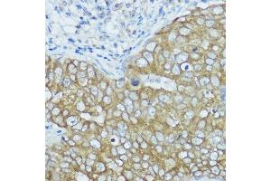 Immunohistochemistry of paraffin-embedded human breast cancer using BSCL2 antibody (ABIN7265874) at dilution of 1:100 (40x lens). (BSCL2 anticorps  (AA 50-150))