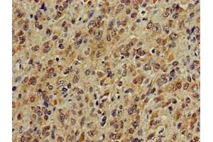 Immunohistochemistry of paraffin-embedded human glioma using ABIN7142041 at dilution of 1:100 (Phospholipase C beta 1 anticorps  (AA 781-896))