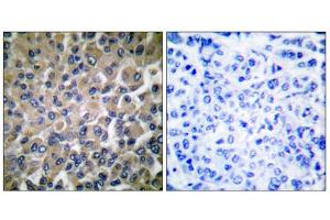 Immunohistochemical analysis of paraffin-embedded human breast carcinoma tissue, using GRP78 antibody (ABIN5976417). (GRP78 anticorps  (C-Term))