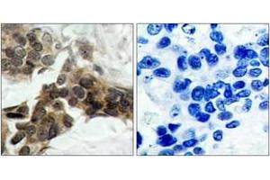 Immunohistochemistry analysis of paraffin-embedded human breast carcinoma, using IkappaB-alpha (Phospho-Ser32/Ser36) Antibody. (NFKBIA anticorps  (pSer32))