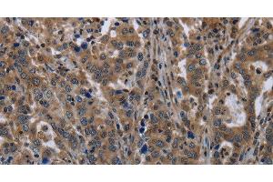 Immunohistochemistry of paraffin-embedded Human liver cancer tissue using TSC22D3 Polyclonal Antibody at dilution 1:40 (TSC22D3 anticorps)