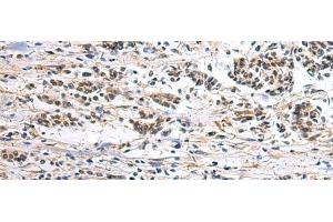 Immunohistochemistry of paraffin-embedded Human breast cancer tissue using CLCN7 Polyclonal Antibody at dilution of 1:105(x200)