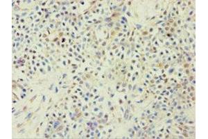 Immunohistochemistry of paraffin-embedded human breast cancer using ABIN7144925 at dilution of 1:100