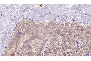 ABIN6273340 at 1/100 staining Human thyroid cancer tissue by IHC-P. (UQCRQ anticorps  (Internal Region))