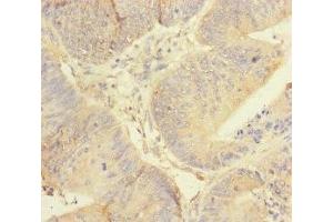 Immunohistochemistry of paraffin-embedded human colon cancer using ABIN7167451 at dilution of 1:100