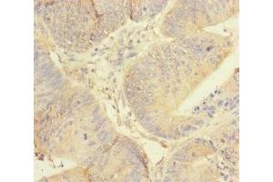 Immunohistochemistry of paraffin-embedded human colon cancer using ABIN7167451 at dilution of 1:100 (REEP5 anticorps  (AA 120-189))