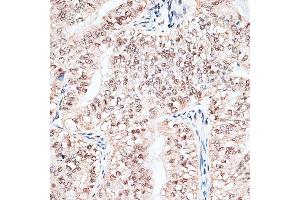 Immunohistochemistry of paraffin-embedded human endometrium cancer using RBM3 antibody  at dilution of 1:100 (40x lens).