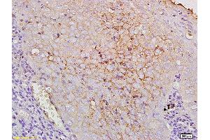 Formalin-fixed and paraffin human laryngocarcinoma labeled with Anti-CD44V10 Polyclonal Antibody, Unconjugated at 1:200, followed by conjugation to the secondary antibody and DAB staining. (CD44v10 (AA 218-227) anticorps)