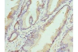 Immunohistochemistry of paraffin-embedded human prostate cancer using ABIN7155947 at dilution of 1:100 (HAPLN1 anticorps  (AA 165-354))