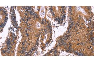Immunohistochemistry of paraffin-embedded Human colon cancer using SEPT7 Polyclonal Antibody at dilution of 1:50