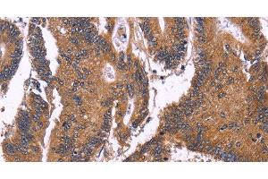 Immunohistochemistry of paraffin-embedded Human colon cancer using SEPT7 Polyclonal Antibody at dilution of 1:50 (Septin 7 anticorps)
