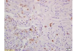 Formalin-fixed and paraffin embedded human lung carcinoma labeled with Rabbit Anti CD79A/IGBP-1 Polyclonal Antibody, Unconjugated (ABIN727578) at 1:200 followed by conjugation to the secondary antibody and DAB staining (IGBP1 anticorps  (AA 151-250))