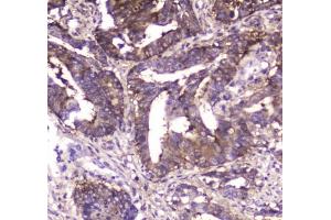 IHC testing of FFPE human intestinal cancer tissue with MVP antibody at 1ug/ml. (MVP anticorps)