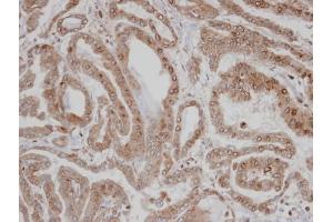 IHC-P Image Immunohistochemical analysis of paraffin-embedded human thyroid cancer, using CAMK1D , antibody at 1:100 dilution. (CAMK1D anticorps)