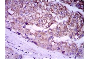 Immunohistochemical analysis of paraffin-embedded liver cancer tissues using GPC3 mouse mAb with DAB staining. (Glypican 3 anticorps)