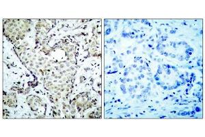 Immunohistochemical analysis of paraffin-embedded breast carcinoma, using MKK6 (epitope around residue 207) Antibody (ABIN5976227). (MAP2K3 anticorps  (Ser207))