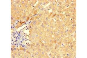 Immunohistochemistry of paraffin-embedded human liver cancer using ABIN7154281 at dilution of 1:100 (GMPR anticorps  (AA 1-345))