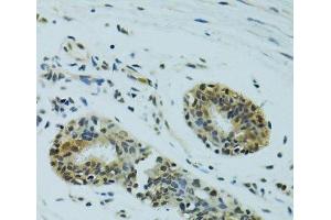 Immunohistochemistry of paraffin-embedded Human breast cancer using NHEJ1 Polyclonal Antibody at dilution of 1:100 (40x lens).