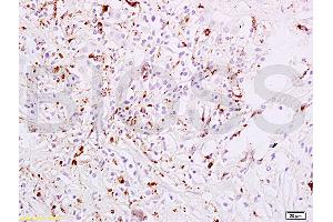 Formalin-fixed and paraffin embedded human liver carcinoma tissue labeled with Anti-phospho-STAT6(Tyr641) Polyclonal Antibody, Unconjugated (ABIN734483) at 1:200 followed by conjugation to the secondary antibody, (SP-0023), and DAB staining (STAT6 anticorps  (pTyr641))