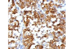 Formalin-fixed, paraffin-embedded human melanoma stained with MART-1 antibody (SPM540).
