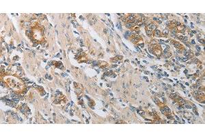 Immunohistochemistry of paraffin-embedded Human gastic cancer using CST3 Polyclonal Antibody at dilution of 1:50 (CST3 anticorps)