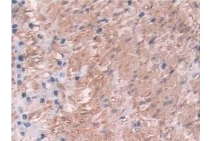 Detection of TAGLN in Human Colorectal cancer Tissue using Polyclonal Antibody to Transgelin (TAGLN)