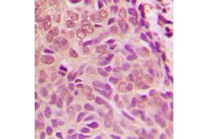 Immunohistochemical analysis of SMAD1 staining in human breast cancer formalin fixed paraffin embedded tissue section.