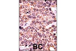 Formalin-fixed and paraffin-embedded human cancer tissue reacted with the primary antibody, which was peroxidase-conjugated to the secondary antibody, followed by AEC staining. (p21 anticorps  (pThr145))