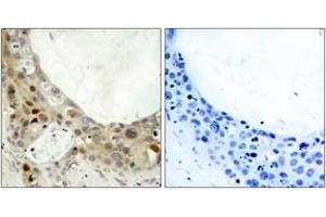 Immunohistochemistry analysis of paraffin-embedded human breast carcinoma, using BCL-2 (Phospho-Ser70) Antibody. (Bcl-2 anticorps  (pSer70))