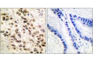 Immunohistochemistry analysis of paraffin-embedded human lung carcinoma tissue, using C/EBP-beta (Ab-235/188) Antibody. (CEBPB anticorps  (AA 201-250))