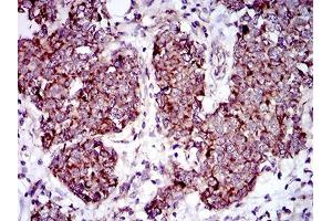 Immunohistochemical analysis of paraffin-embedded breast cancer tissues using MRPL42 mouse mAb with DAB staining. (MRPL42 anticorps  (AA 10-142))