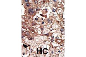 Formalin-fixed and paraffin-embedded human hepatocellular carcinoma tissue reacted with EPS8 polyclonal antibody  , which was peroxidase-conjugated to the secondary antibody, followed by DAB staining. (EPS8 anticorps  (N-Term))