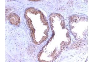 Formalin-fixed, paraffin-embedded human Prostate Carcinoma stained with PSA Rabbit Recombinant Monoclonal Antibody (KLK3/2871R). (Recombinant Prostate Specific Antigen anticorps)