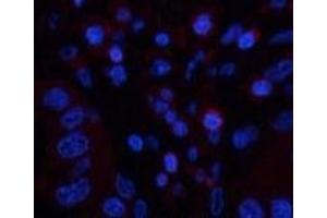 Immunofluorescence analysis of Human liver cancer tissue using CD45 Monoclonal Antibody at dilution of 1:200.